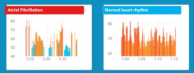 سنسور ضربان قلب اپل واچ نارسایی قلبی را با دقتی بالا تشخیص می‌دهد